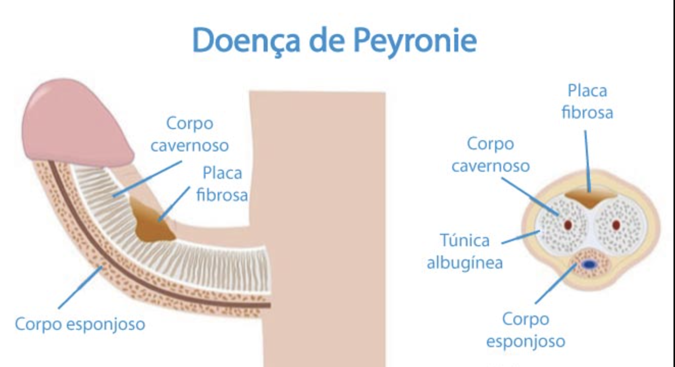 Doença de Peyronie: sintomas, diagnóstico e tratamento